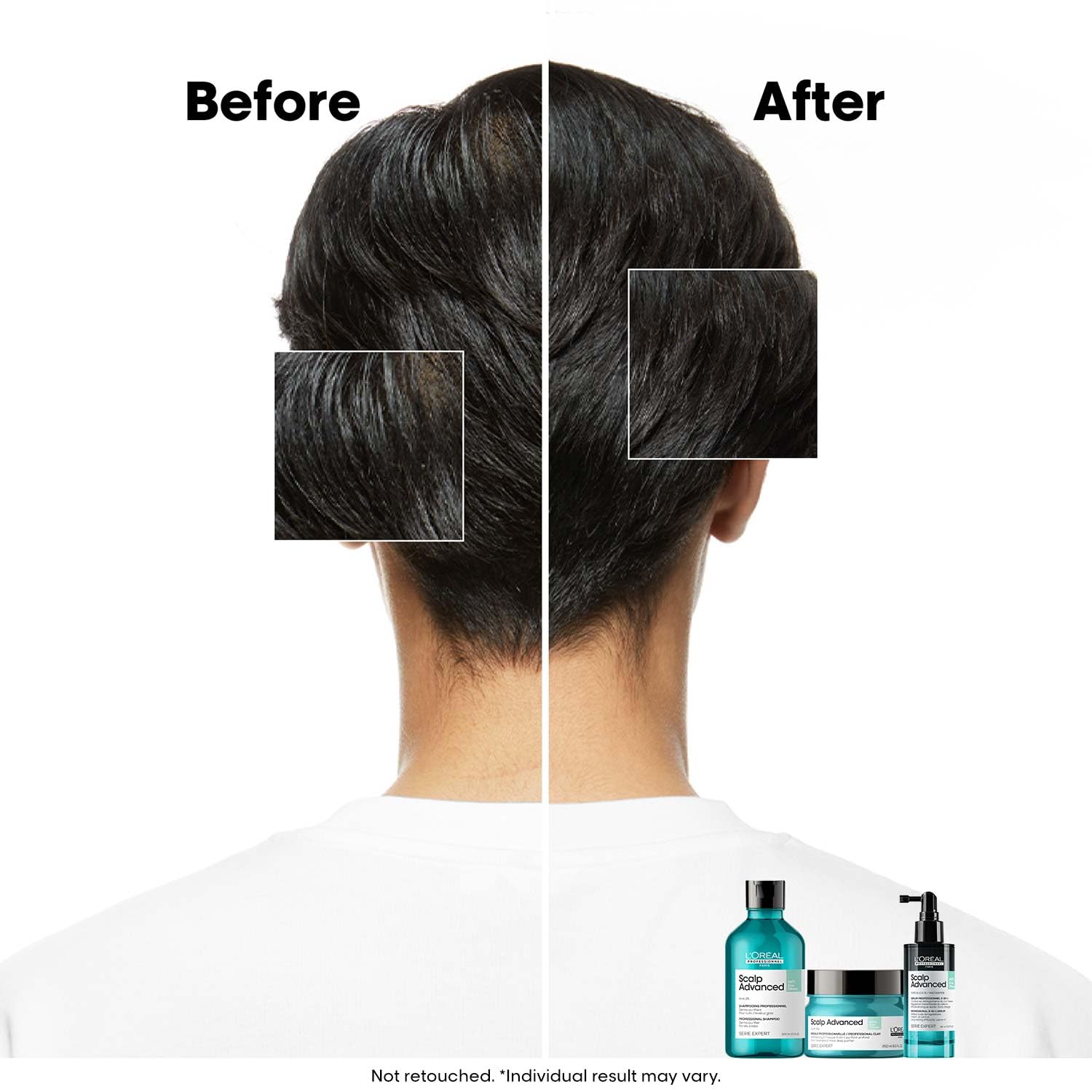LOREAL SCALP ADVANCE ANTI OILNESS SHAMPOO