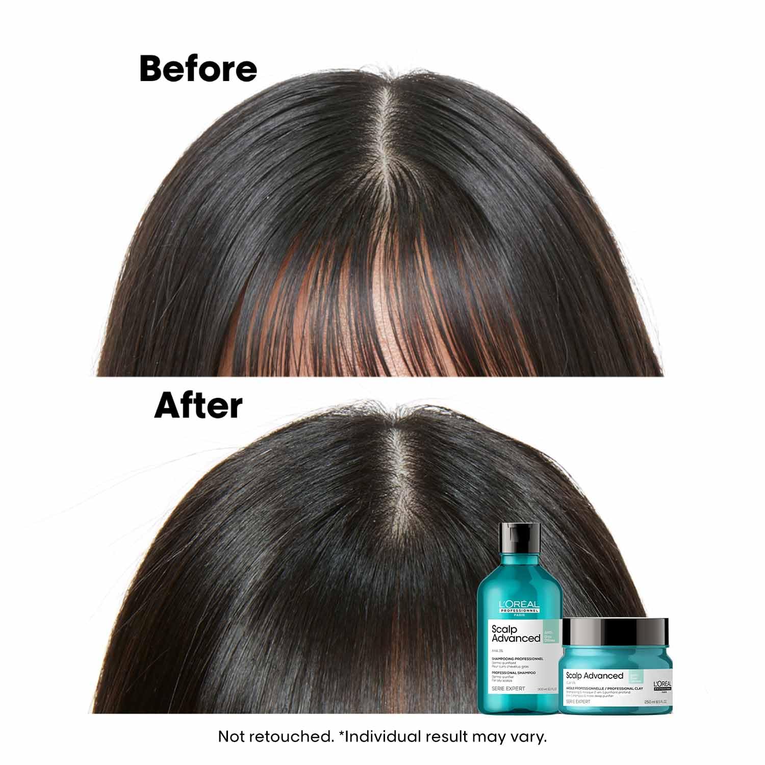 LOREAL SCALP ADVANCE ANTI OILNESS SHAMPOO